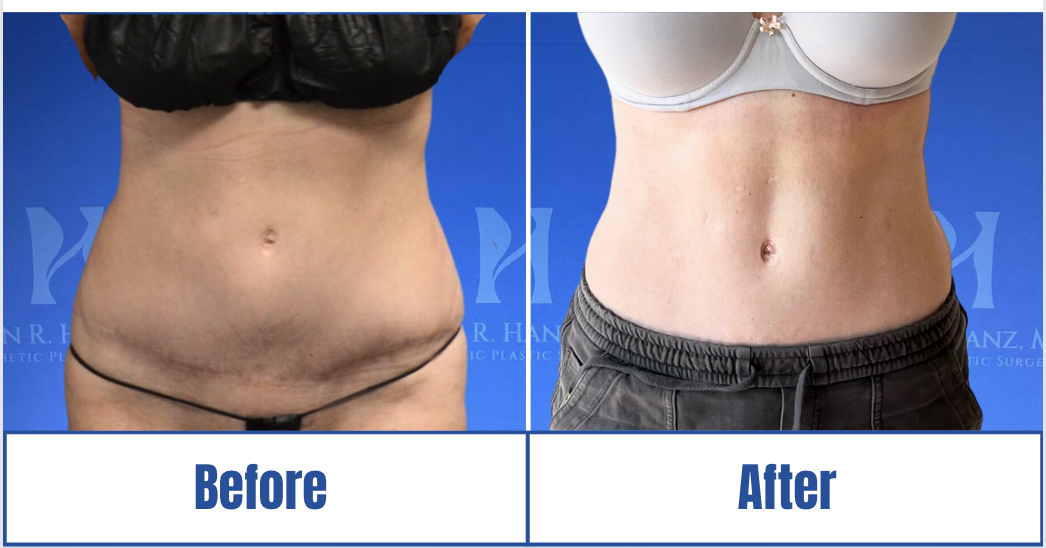 Liposuction View 100_2
