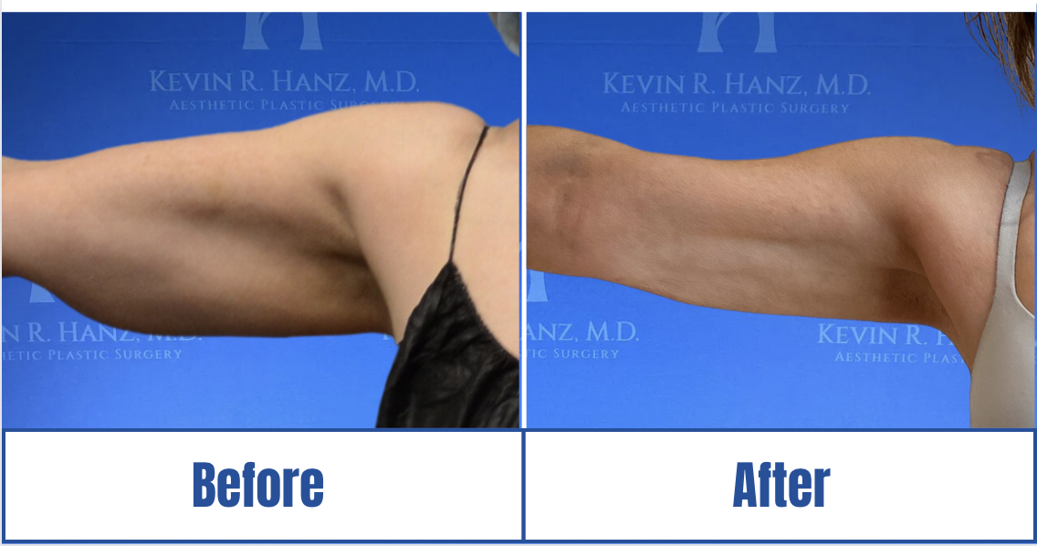detailed face lift before and after photos