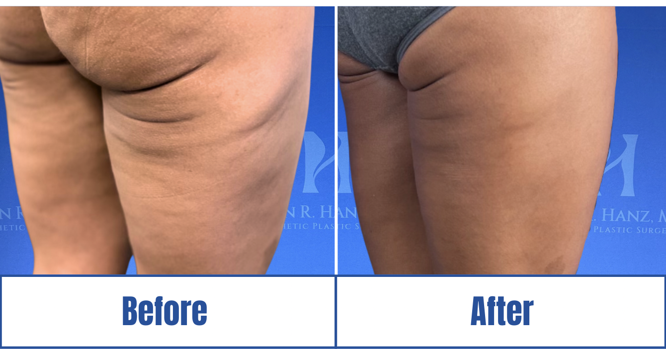 detailed face lift before and after photos