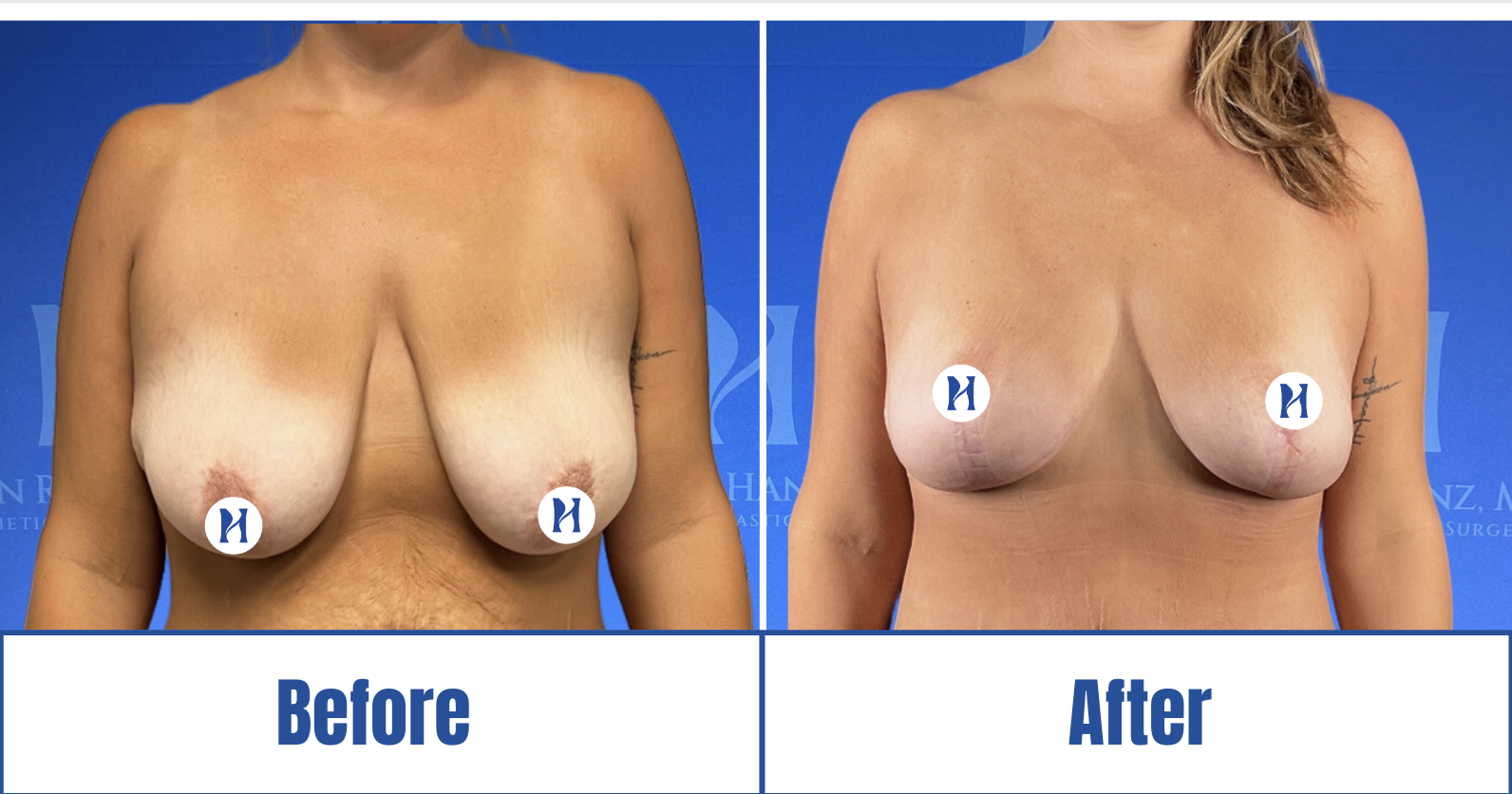 Breast Augmentation View 1