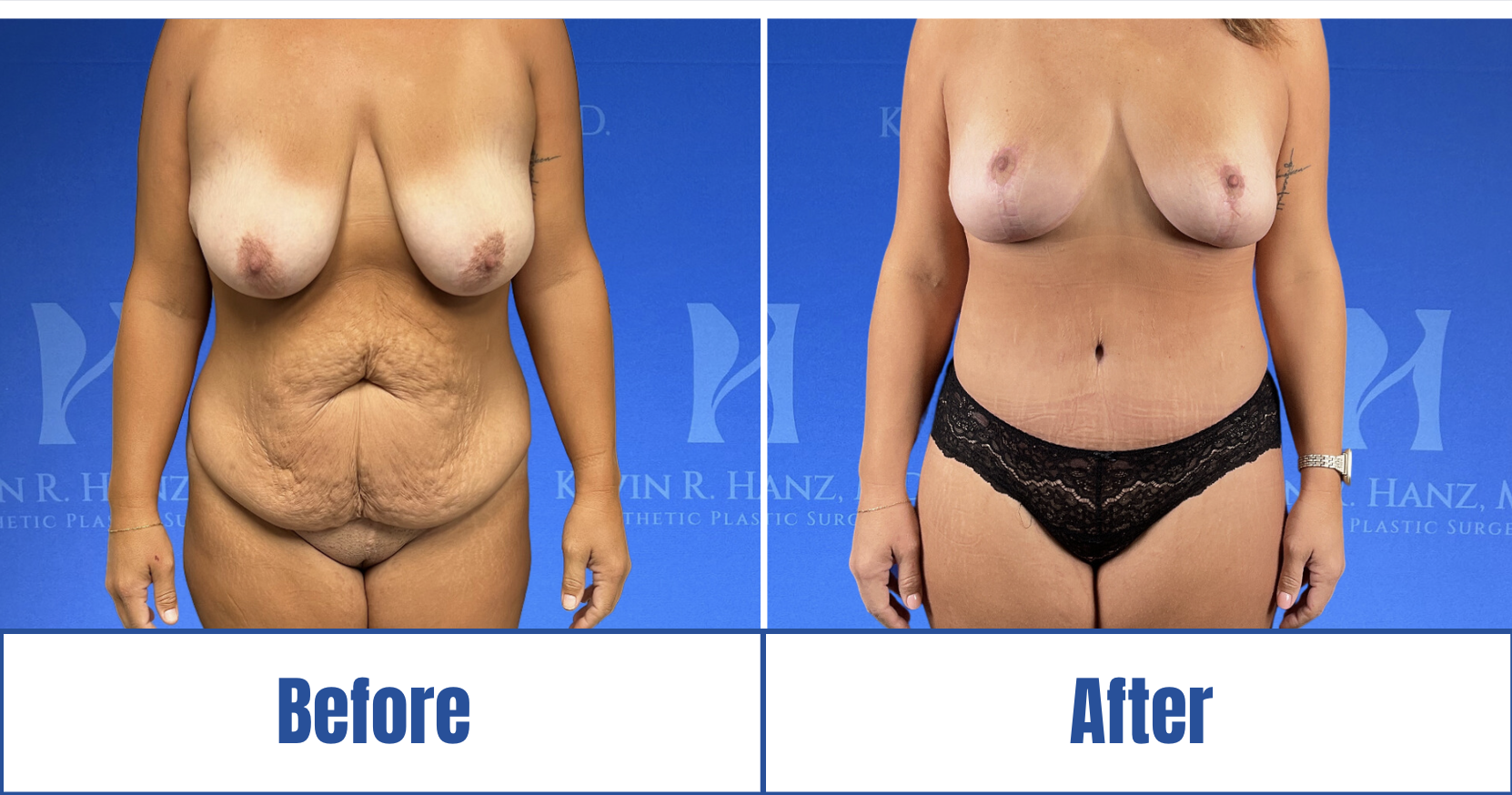 Mommy Makeover Image View 1