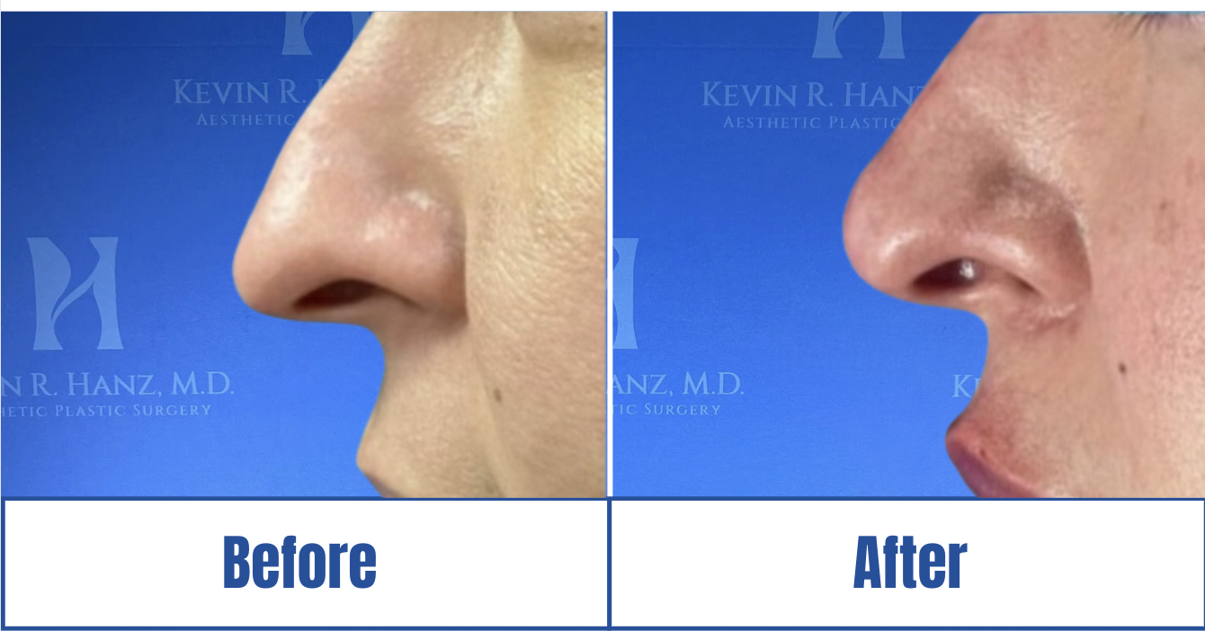 Lip Fillers View 1