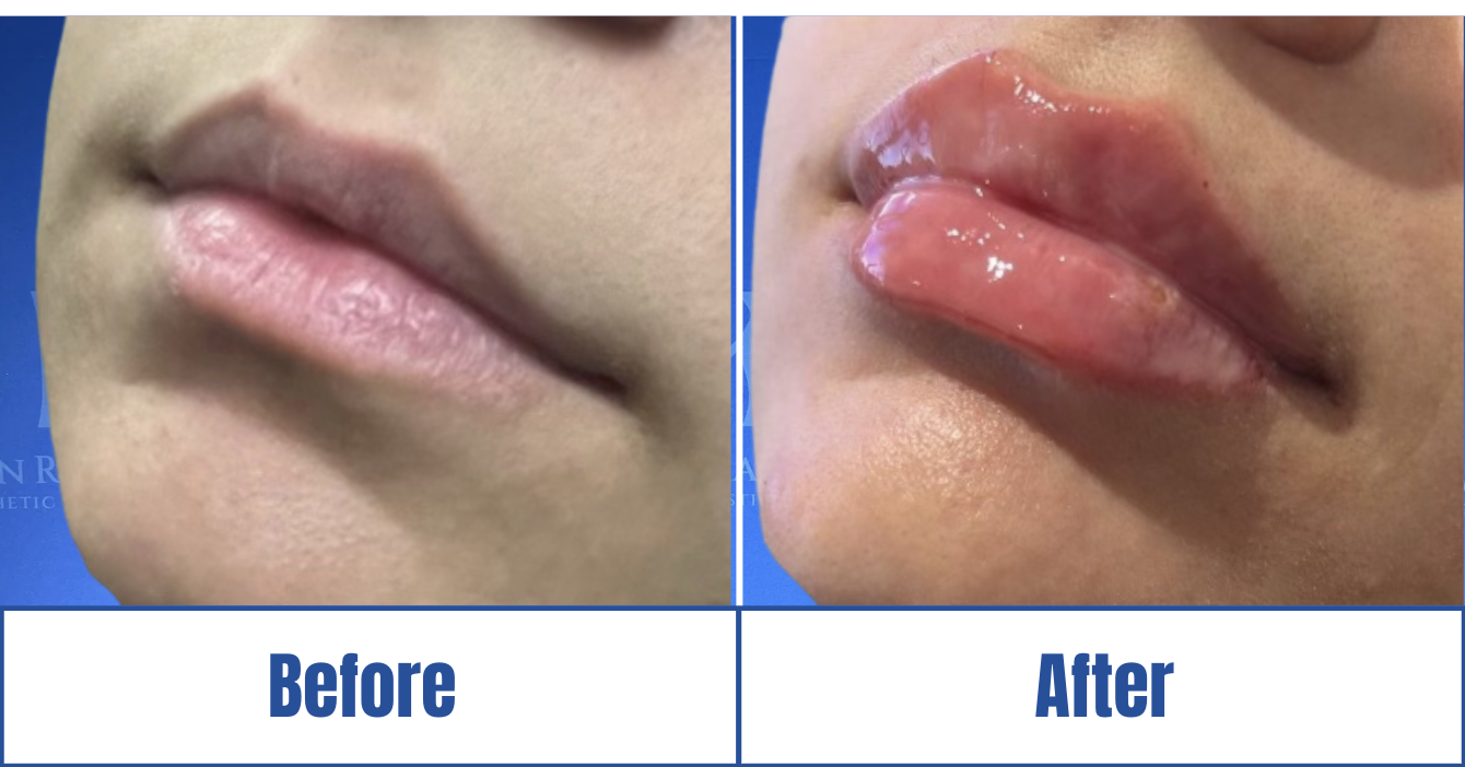 Lip Fillers View 1