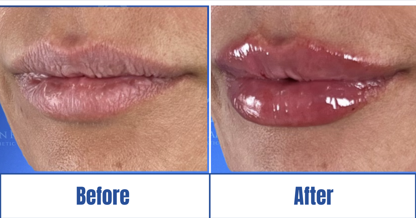 Lip Fillers View 1