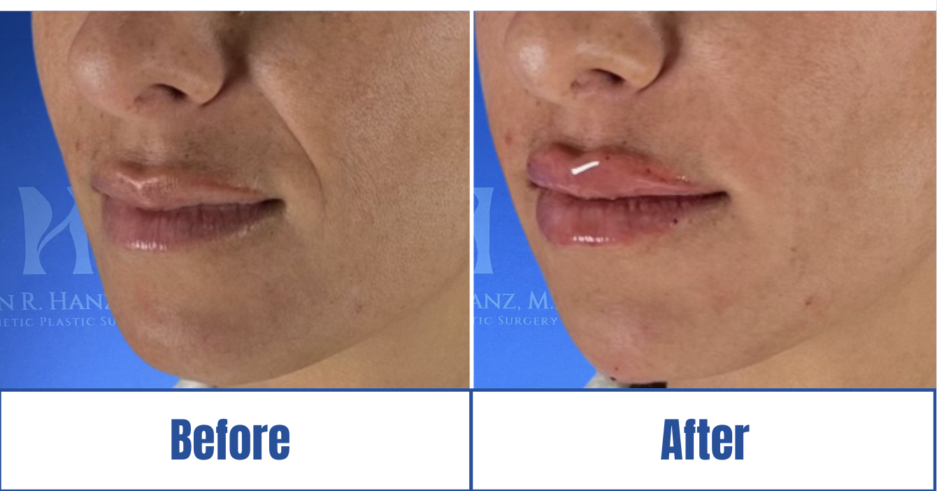 Lip Fillers View 1