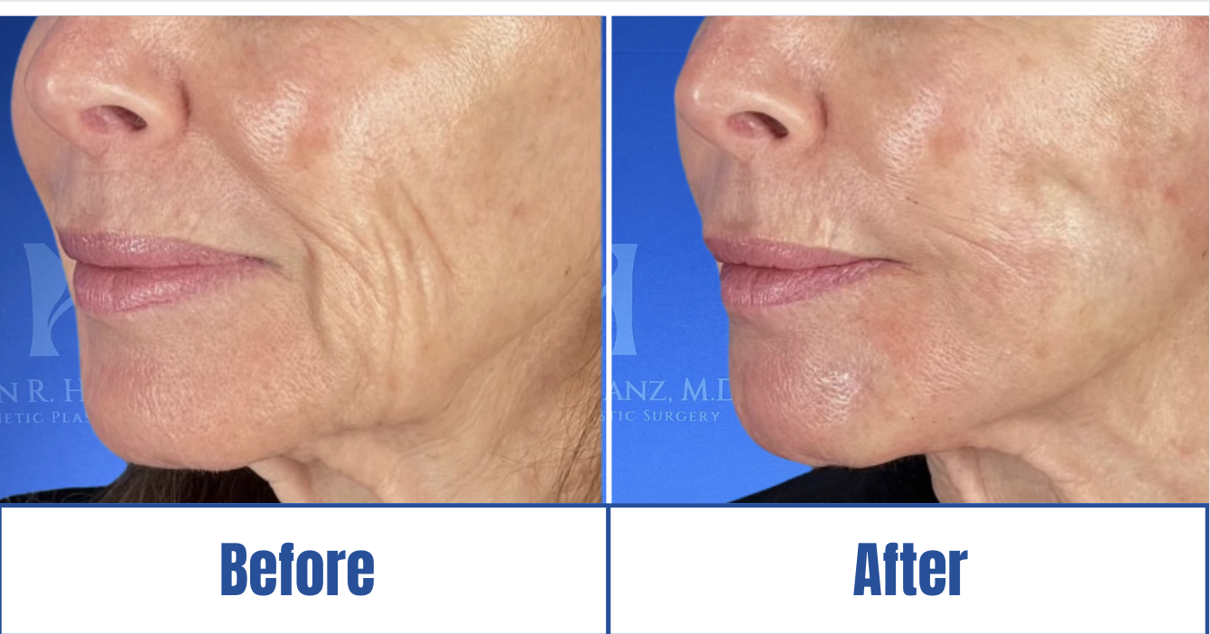detailed face lift before and after photos