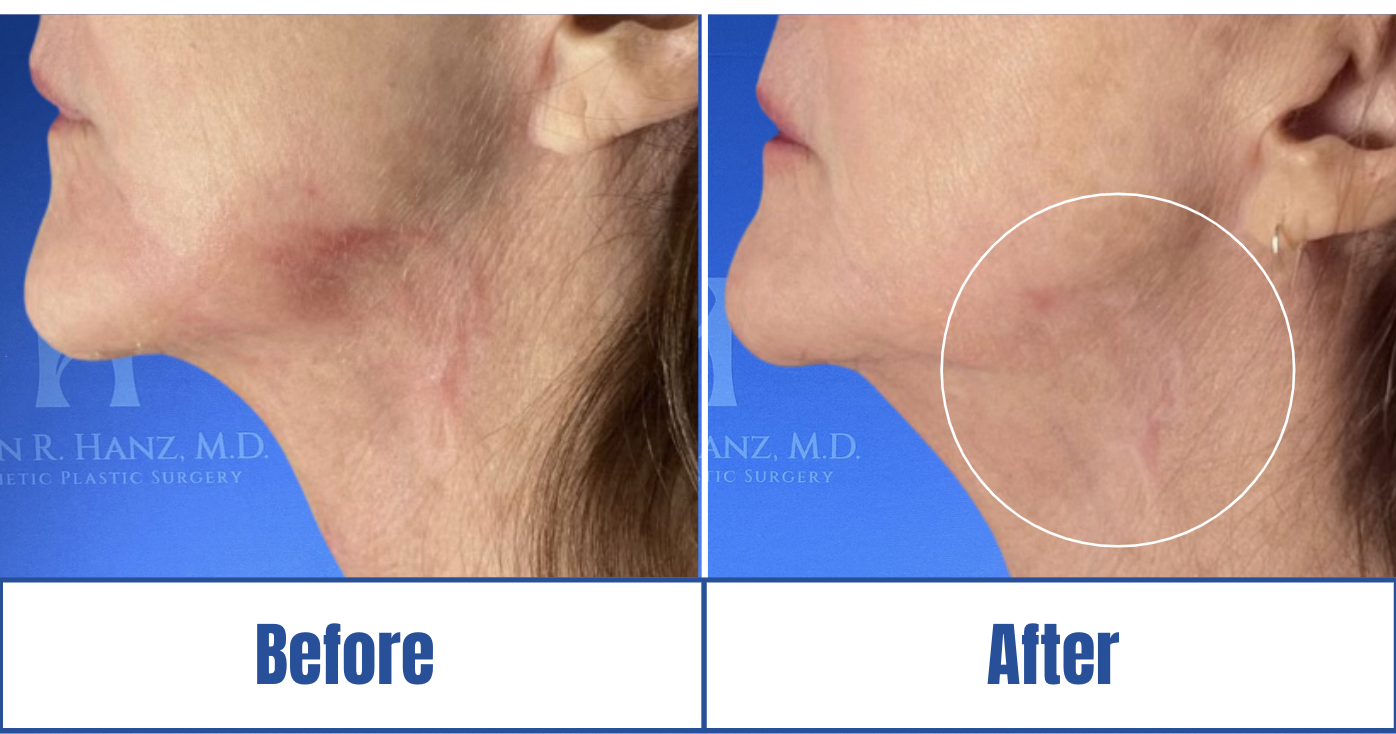 detailed face lift before and after photos