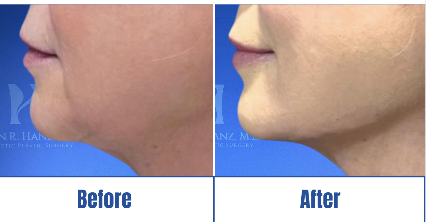 Lip Fillers View 1