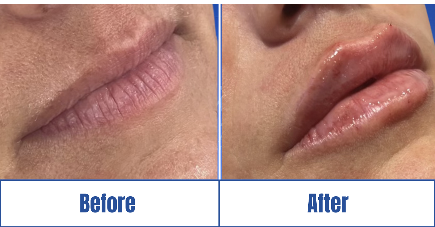 Lip Fillers View 1