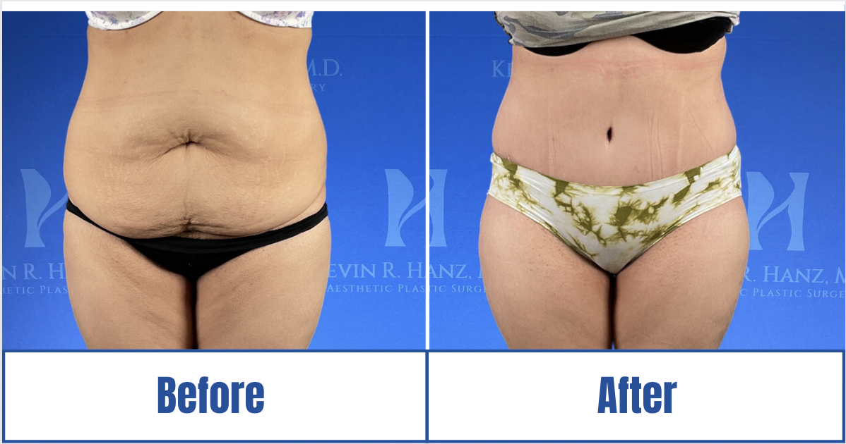 Liposuction View 1_1