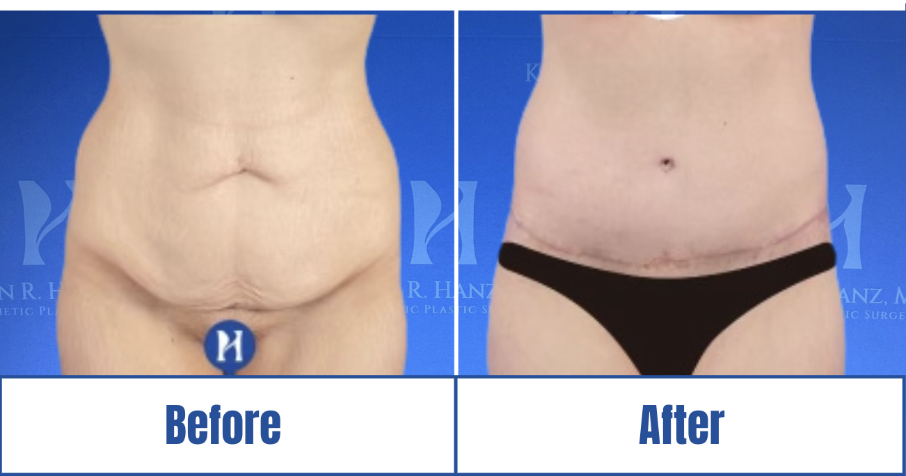 Liposuction View 1_1