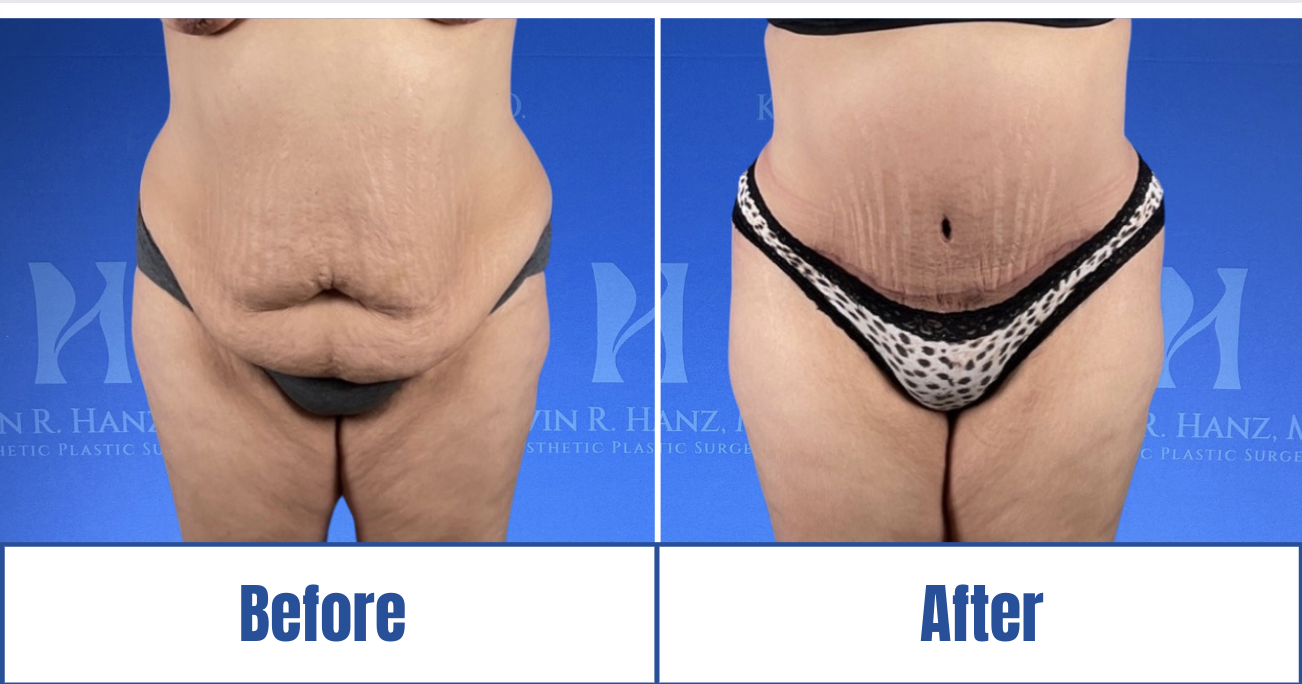 Liposuction View 1_1