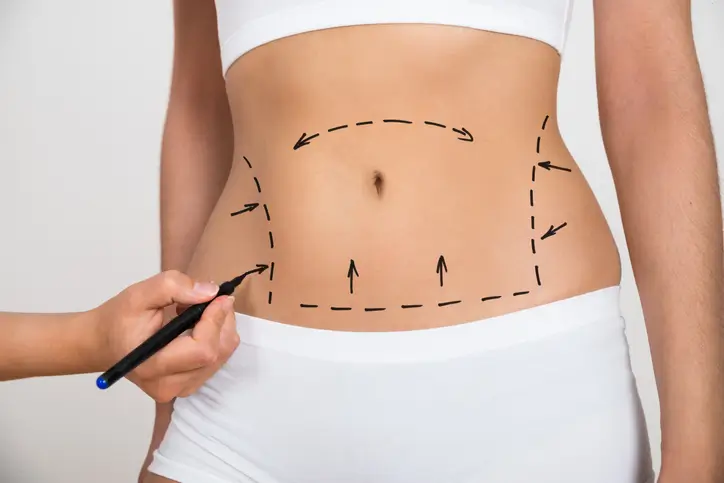 Surgeon drawing lines on a woman's abdomen as marks for liposuction surgery