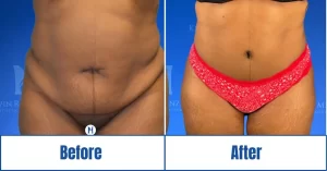 abdominoplasty-surgery-dallas-tx Abdominoplasty surgery in Dallas, TX<br />