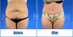 Before and after abdominoplasty surgery in Dallas, TX<br />
