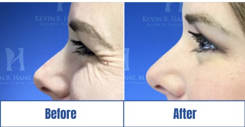 A before and after image of a woman who received Botox under eye treatment in Dallas, TX.