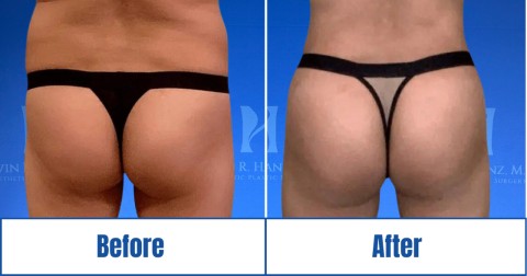Before & after image of a woman who got Brazilian butt lift treatment in Dallas Fort Worth