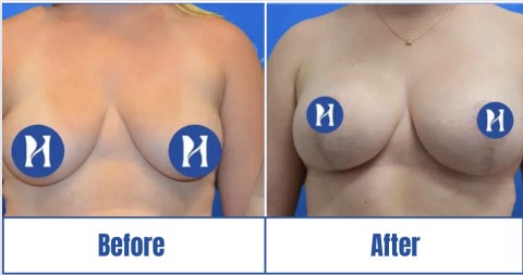 Before & after image of a woman who got Breast Augmentation in Dallas Fort Worth