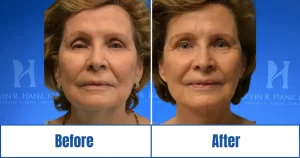 Before and after facelift of septuagenarian
