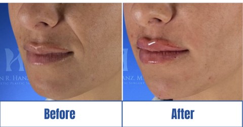 Before & after image of a woman who got Lip Filler treatment in Dallas Fort Worth