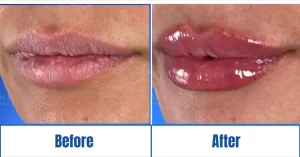Before and after lip fillers<br />
