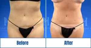 Before and after Liposuction 360
