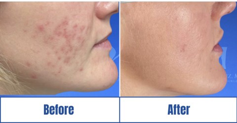 Before & after image of a woman who got Skin Restoration treatment in Dallas Fort Worth