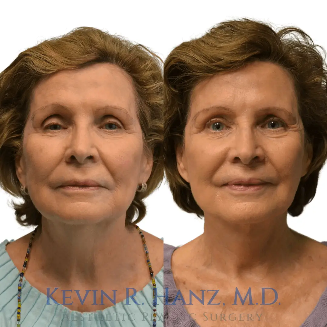 facelift-necklift facelift of a 70-year-old woman before and after