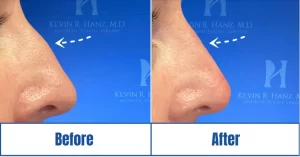 Before and after liquid rhinoplasty surgery<br />
