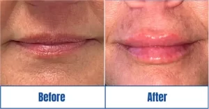 nonsurgical-lip-filler-before-after "Before and after non-surgical lip filler injections "<br />