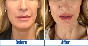 TriLift before and after of middle-aged woman
