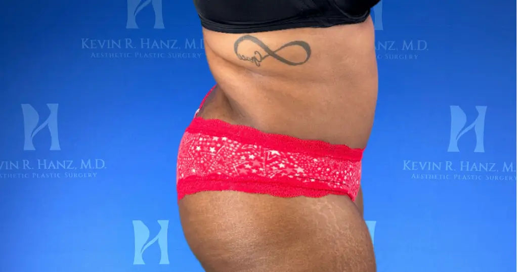 woman-after-abdominoplasty-side-view Woman after abdominoplasty side view