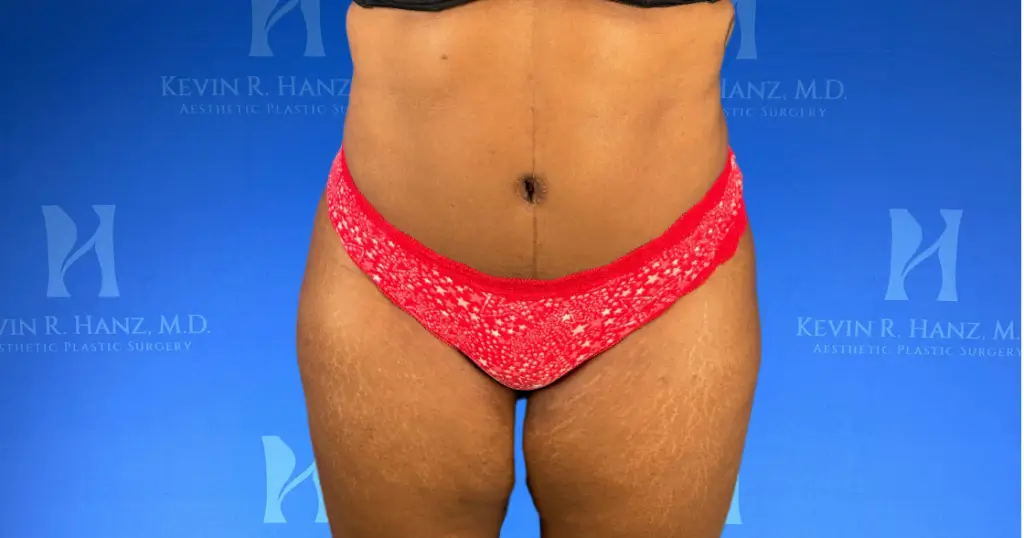 woman-after-abdominoplasty Woman after abdominoplasty