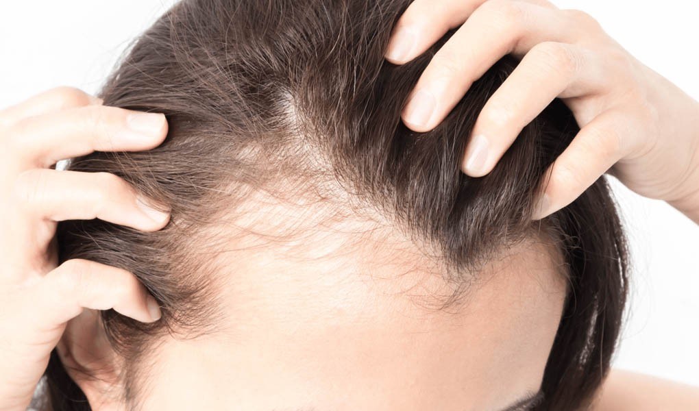 A woman experiencing loss of hair seeking hair fall treatment in Dallas Fort Worth