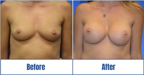 Before & after image of a patient who got Breast Augmentation in Dallas Fort Worth