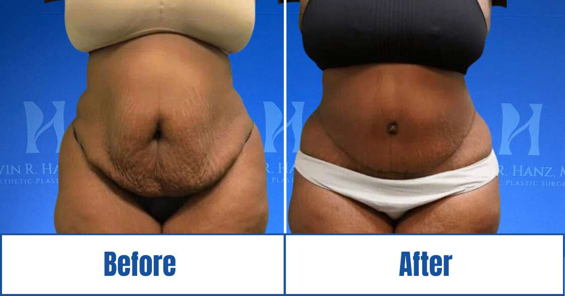 before-after-of-abdominoplasty Before and After View of Abdominoplasty Treatments in Dallas, TX
