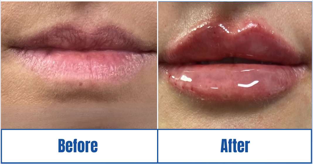 Before and After View of Woman Highlighting Lip Filler Treatments in Dallas, TX