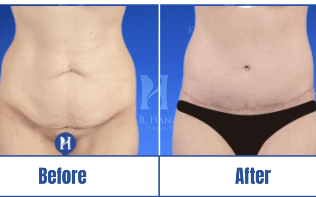 before-and-after-abdominoplasty Before and after image of a woman who underwent abdominoplasty in Dallas, TX