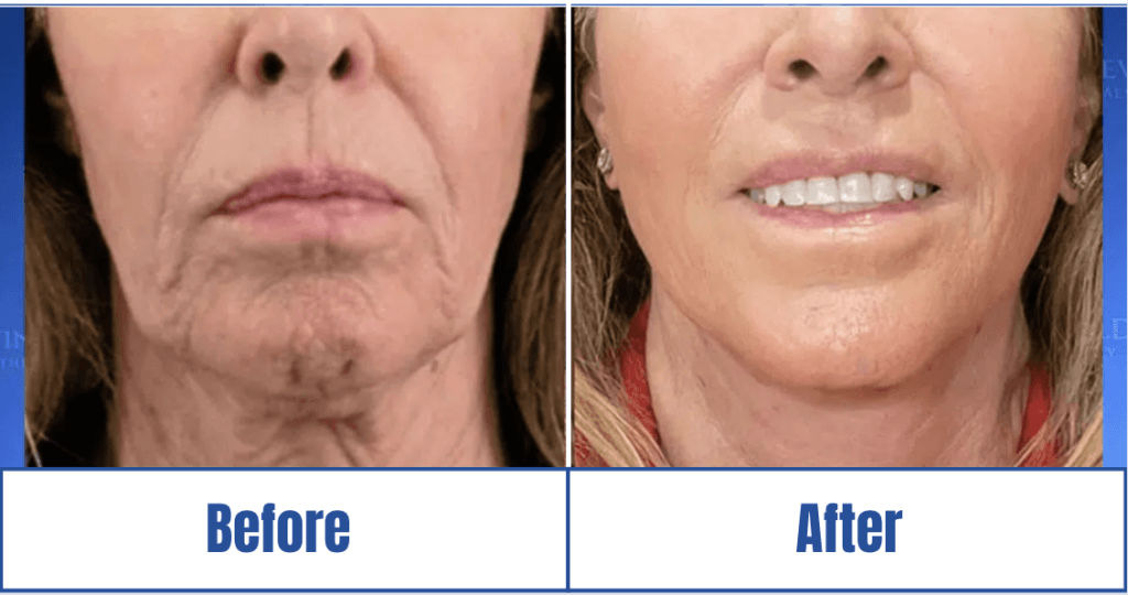 before-and-after-face-lift A clear before and after image of a woman who underwent facelift surgery in Dallas, TX.