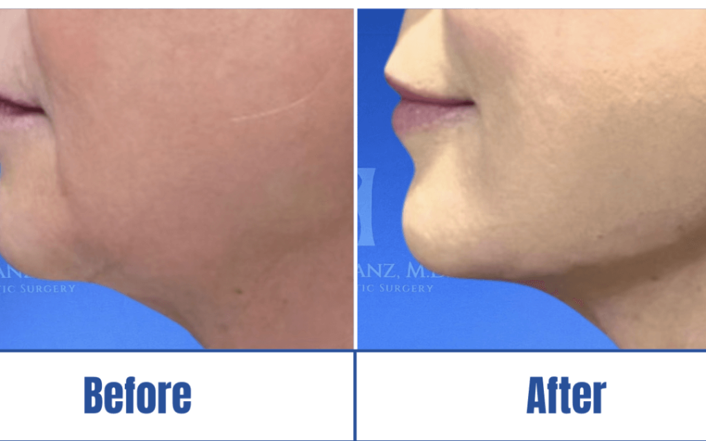 before-and-after-jawline-filler A before and after image of a woman who underwent jawline filler surgery in Dallas, TX.