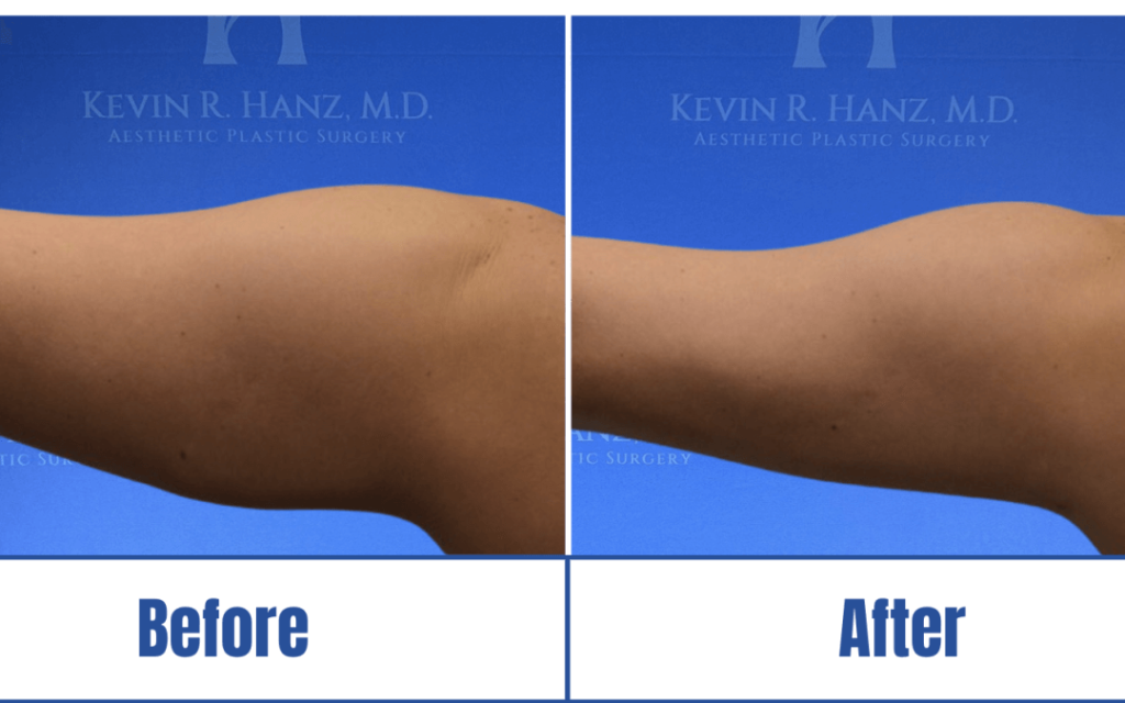 before-and-after-liposuction Before and after image of a woman's arms who underwent liposuction in Dallas, TX.