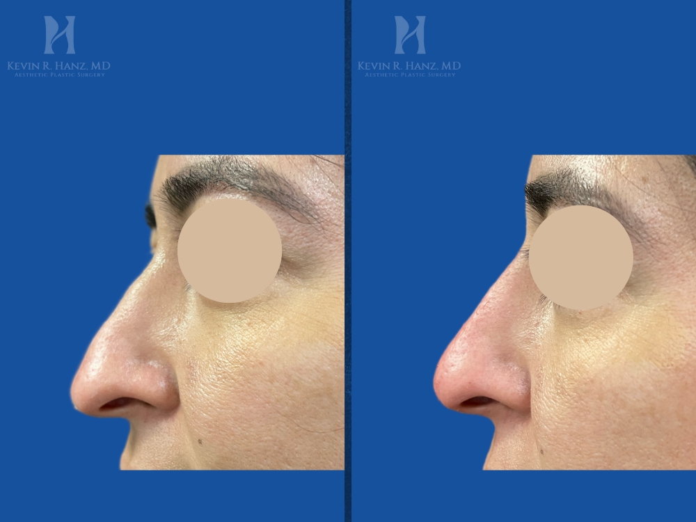 Liquid Rhinoplasty view 2 before and after result of a man in Dallas, Tx