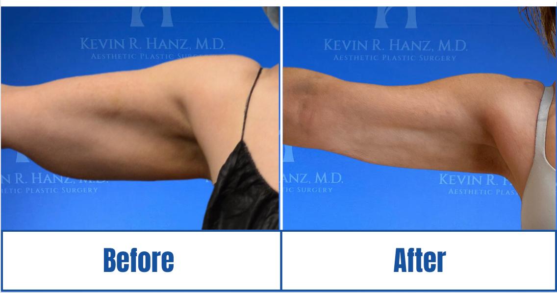 Before and After View of a woman's visible results of Liposuction treatment in Dallas, TX