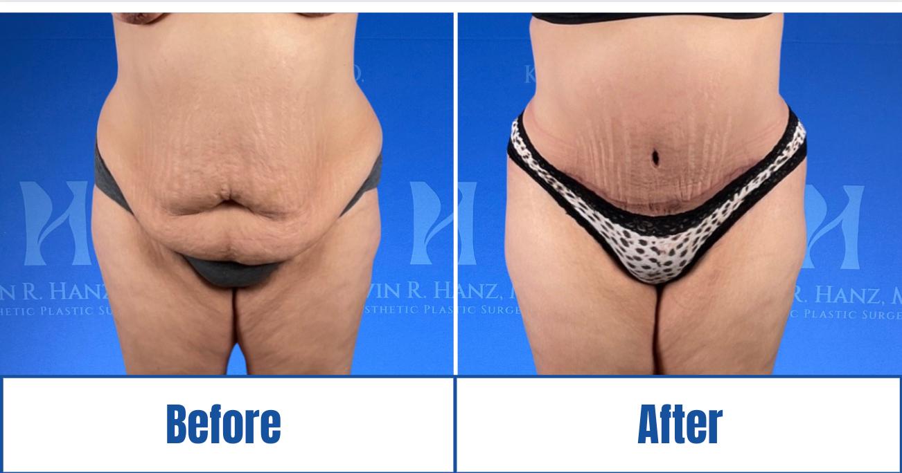 Before and After View of a woman's visible results of abdominoplasty treatment in Dallas, TX