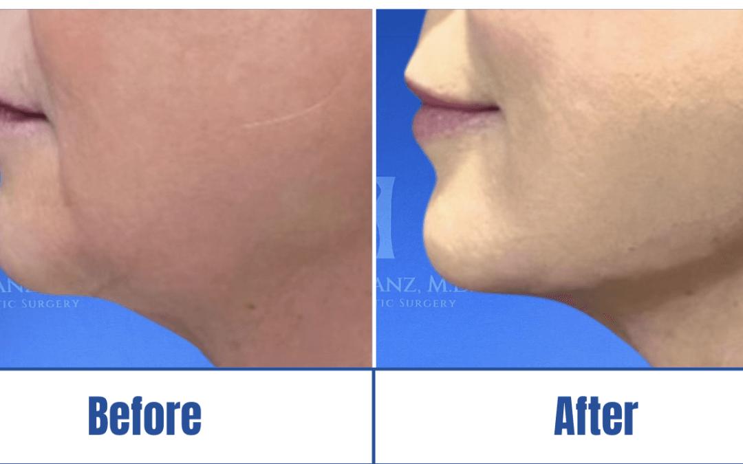 Before and after image of a woman who underwent face and neck lift in Dallas, TX
