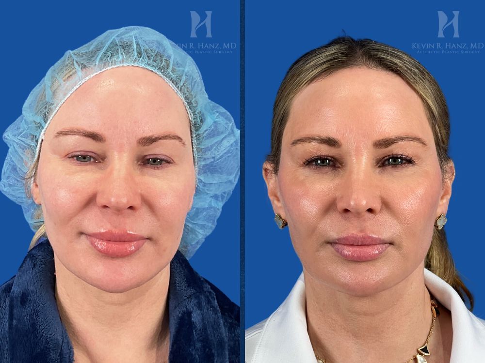 ace lift Ace Lift results in Dallas-Fort Worth smoother, youthful look shown in this before-and-after image
