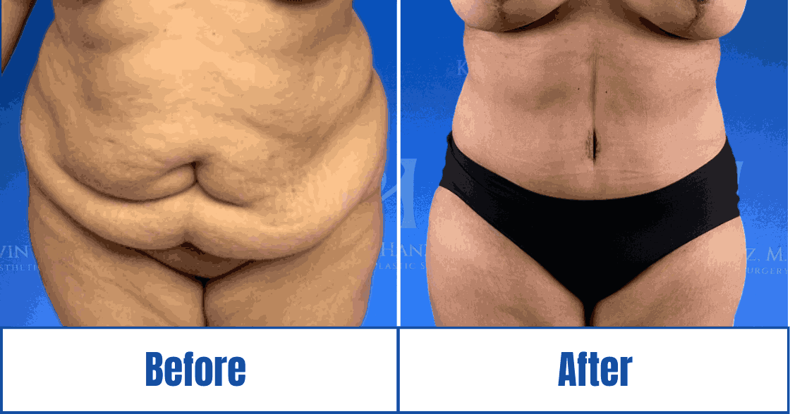 aesthetic enhancement results Aesthetic enhancement results of a patient in the Dallas-Fort Worth Metropolitan Area<br />