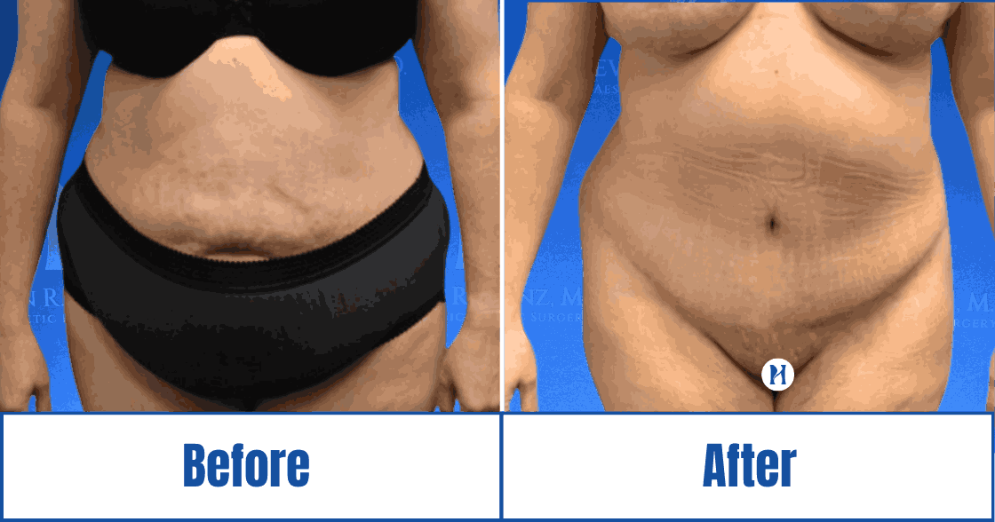 cosmetic transformation Cosmetic transformation imagery featuring a patient in the Dallas-Fort Worth Metropolitan Area<br />