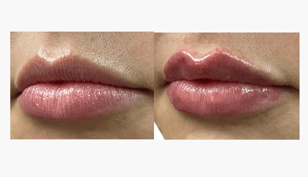enhanced lip volume Fillers in Dallas-Fort Worth: enhanced lip volume and shape shown in this before-and-after image<br />