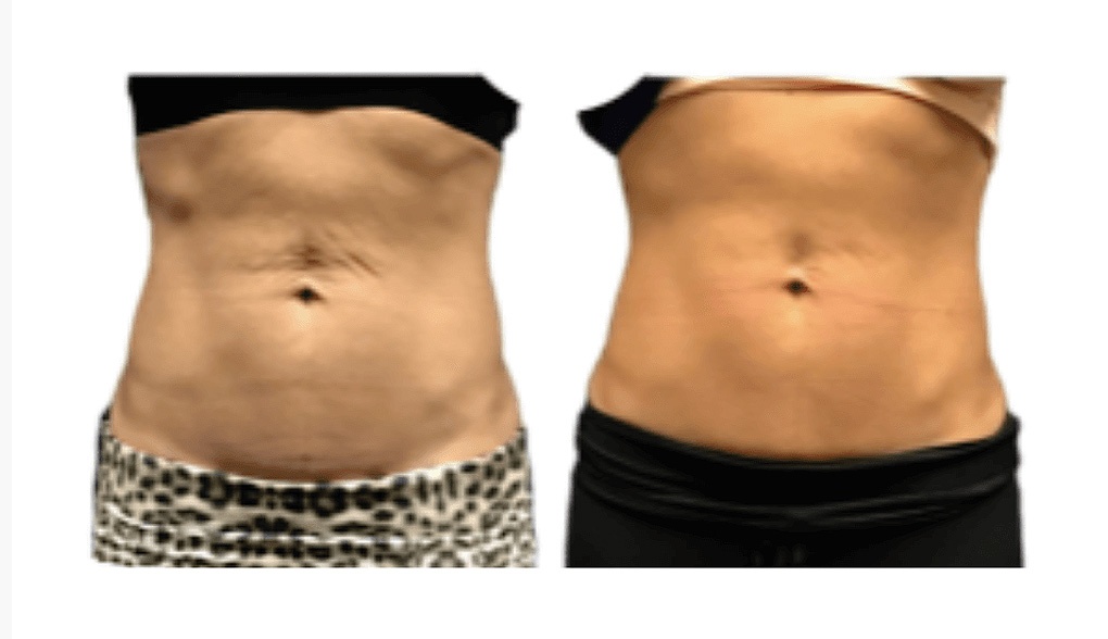 evolvetite EvolveTite® by InMode in Dallas-Fort Worth: tighter, smoother abs in this body contour result<br />